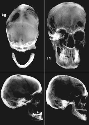 Pig's Meadow - The graves - The evidence